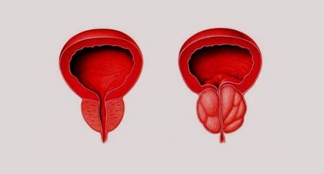 Gezonde prostaat (links) en ontstoken door prostatitis (rechts)