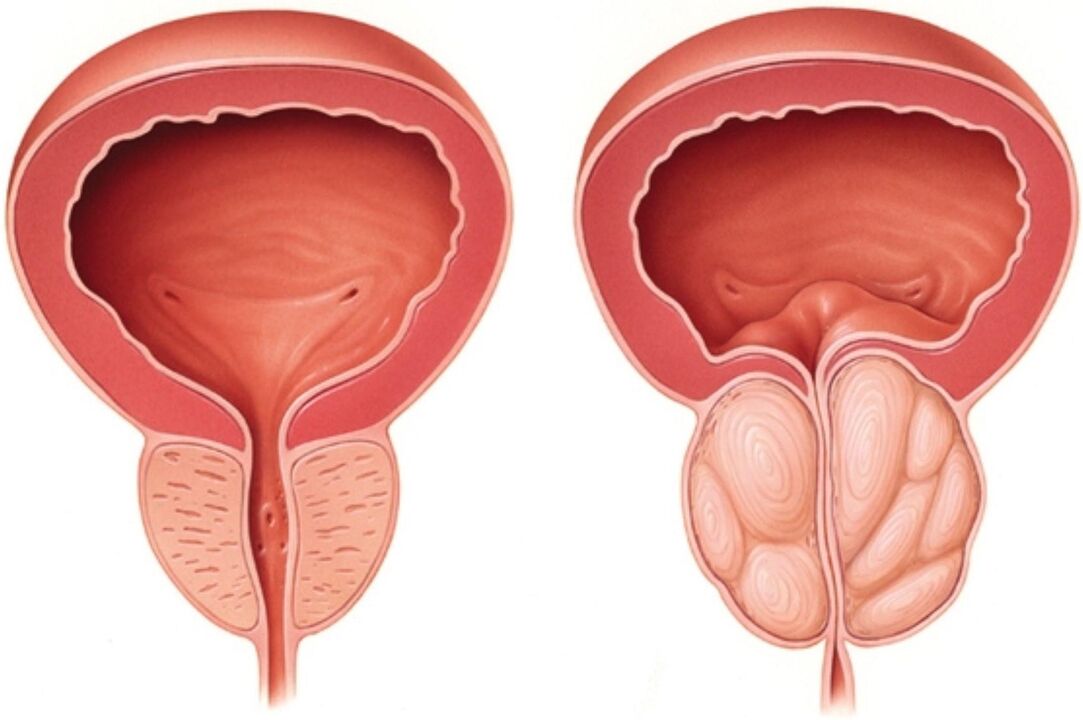 Normale prostaat (links) en met tekenen van ontsteking bij prostatitis (rechts)