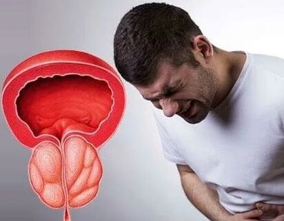 Symptomen van chronische prostatitis bij mannen