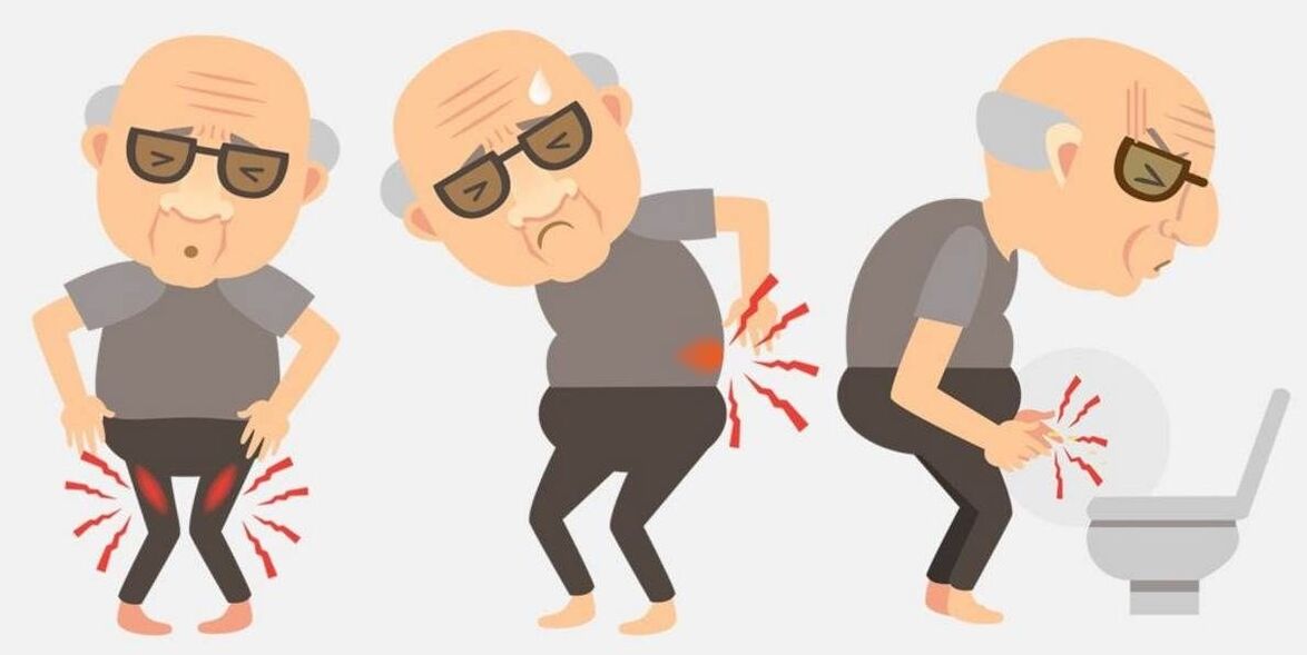 symptomen van prostatitis