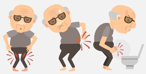 symptomen van prostatitis en de behandeling ervan met medicijnen