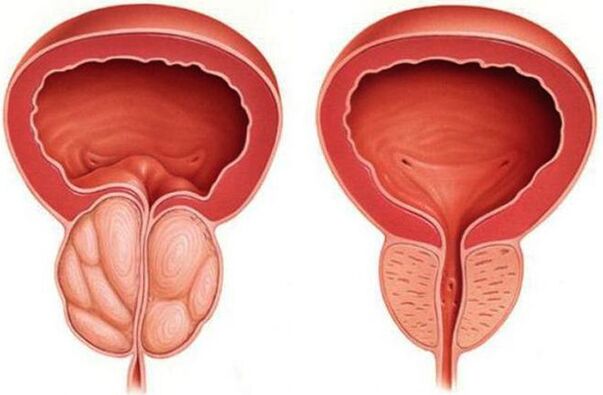 gezonde en ontstoken prostaat met prostatitis